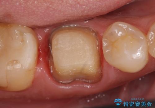 オールセラミッククラウン 咬むと疼く銀歯の治療の治療中
