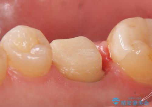 オールセラミッククラウン 咬むと疼く銀歯の治療の治療中