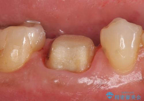 オールセラミッククラウン 咬むと疼く銀歯の治療の治療中