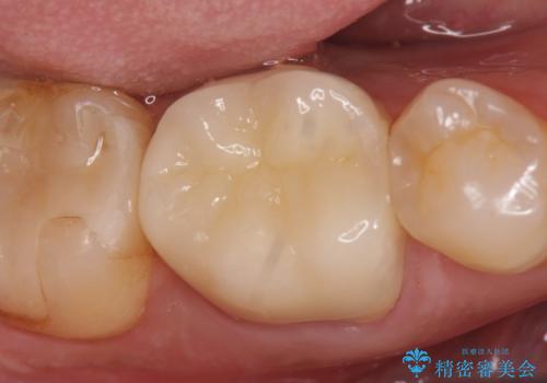 オールセラミッククラウン 咬むと疼く銀歯の治療の治療後