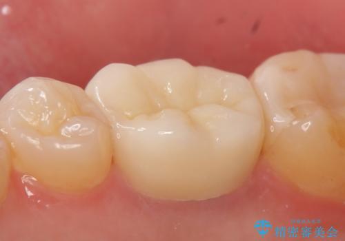 オールセラミッククラウン 咬むと疼く銀歯の治療の治療後