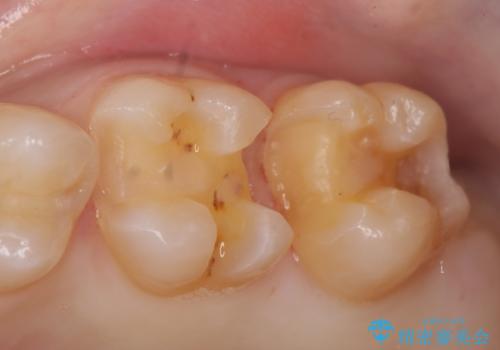 セラミックインレー 銀歯の下の縁下カリエス(歯茎より深い虫歯)の治療の治療中