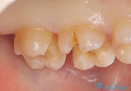 セラミックインレー　銀歯の下の縁下カリエス(歯茎より深い虫歯)の治療の治療中