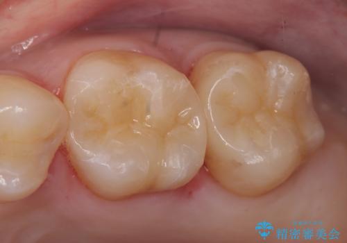 セラミックインレー　銀歯の下の縁下カリエス(歯茎より深い虫歯)の治療の症例 治療後