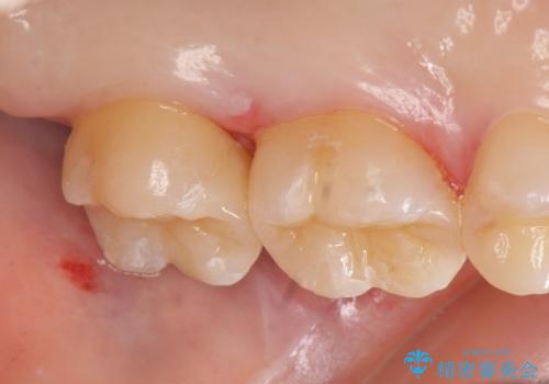 セラミックインレー 銀歯の下の縁下カリエス(歯茎より深い虫歯)の治療の治療後