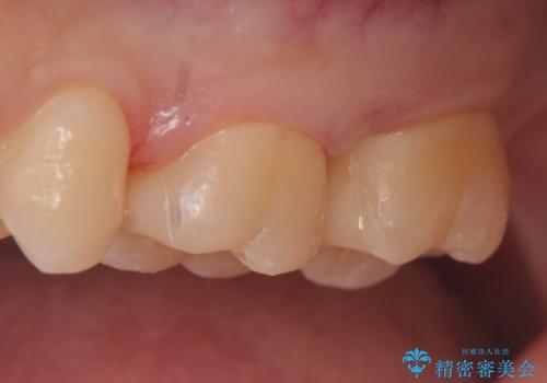 セラミックインレー 銀歯の下の縁下カリエス(歯茎より深い虫歯)の治療の治療後