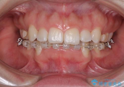 目立たない裏側矯正 抜歯矯正で口元を改善の治療中