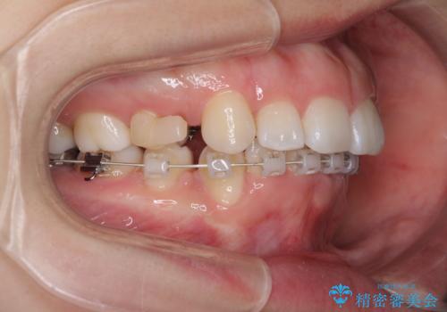 目立たない裏側矯正 抜歯矯正で口元を改善の治療中