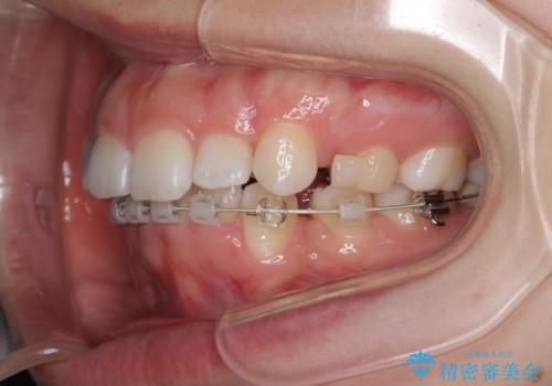 目立たない裏側矯正 抜歯矯正で口元を改善の治療中