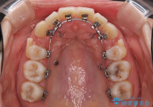 目立たない裏側矯正 抜歯矯正で口元を改善の治療中
