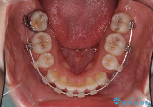 目立たない裏側矯正 抜歯矯正で口元を改善の治療中