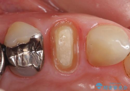 オールセラミッククラウン(エクセレント) 神経まで達してしまった虫歯の治療の治療中