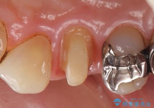 オールセラミッククラウン(エクセレント) 神経まで達してしまった虫歯の治療の治療中