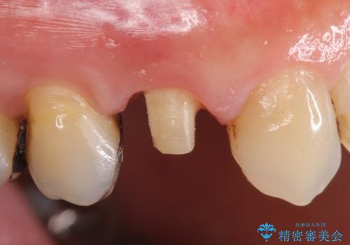 オールセラミッククラウン(エクセレント) 神経まで達してしまった虫歯の治療の治療中