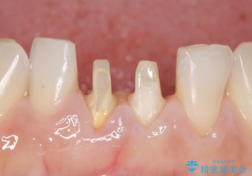 オールセラミッククラウン(スペシャル) 見た目が気になる前歯を綺麗にの治療中