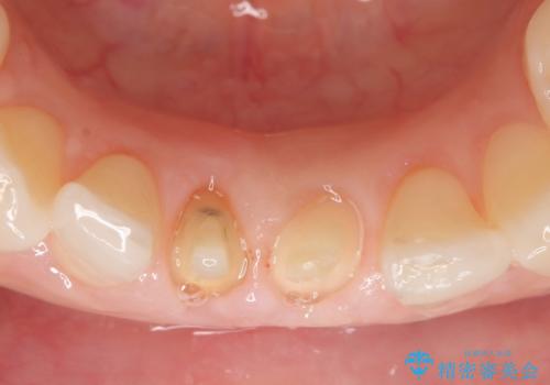 オールセラミッククラウン(スペシャル) 見た目が気になる前歯を綺麗にの治療中