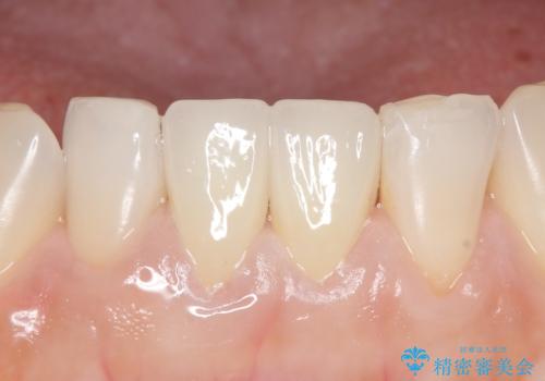 オールセラミッククラウン(スペシャル) 見た目が気になる前歯を綺麗にの治療後