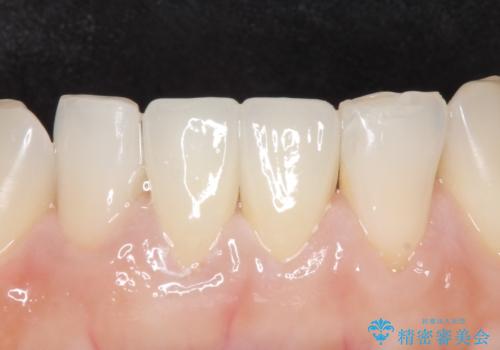 オールセラミッククラウン(スペシャル) 見た目が気になる前歯を綺麗にの治療後