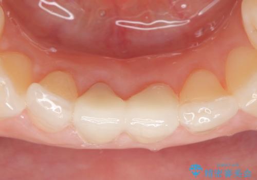 オールセラミッククラウン(スペシャル) 見た目が気になる前歯を綺麗にの治療後