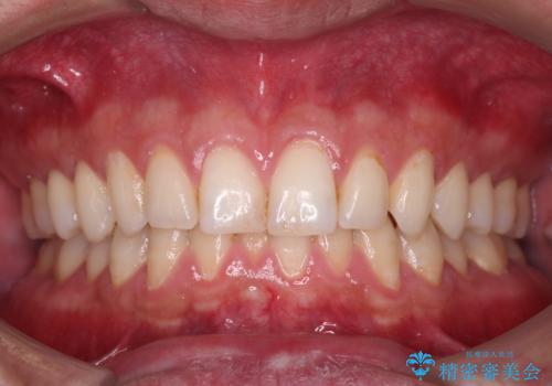 下の前歯のがたがたを治したい。インビザラインライトの治療前