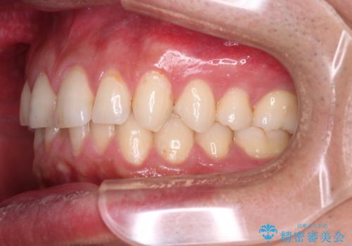 下の前歯のがたがたを治したい。インビザラインライトの治療前