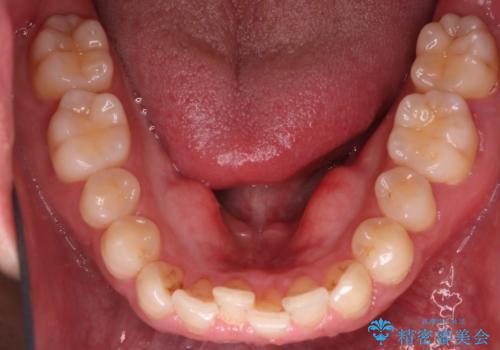 下の前歯のがたがたを治したい。インビザラインライトの治療前