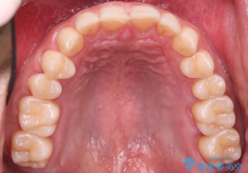 下の前歯のがたがたを治したい。インビザラインライトの治療前