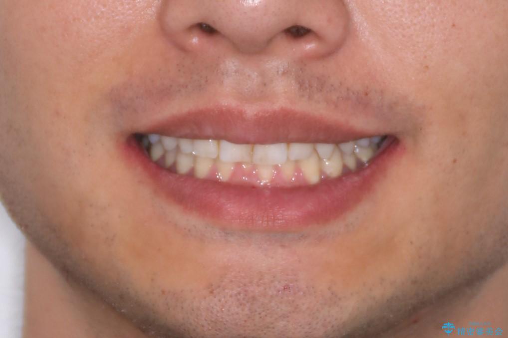 下の前歯のがたがたを治したい。インビザラインライトの治療前(顔貌)