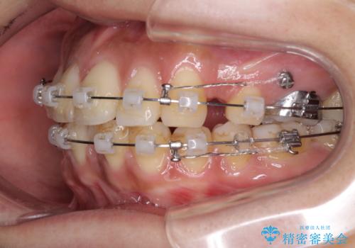 横顔をすっきりさせたい 下の前歯が1本少ない方の変則的な抜歯矯正の治療中