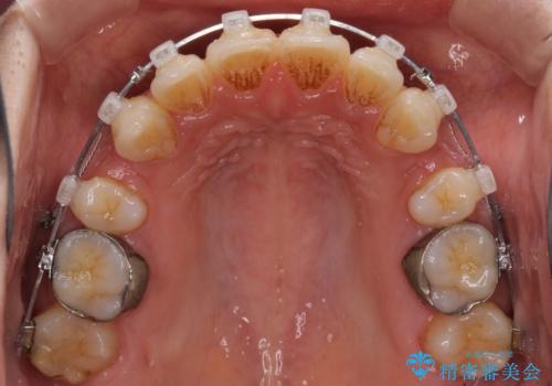 横顔をすっきりさせたい　下の前歯が1本少ない方の変則的な抜歯矯正の治療中