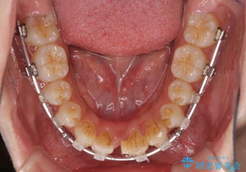 横顔をすっきりさせたい 下の前歯が1本少ない方の変則的な抜歯矯正の治療中