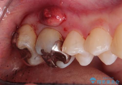 歯茎がはれてきた 根の治療をしてからのセラミック装着の治療前
