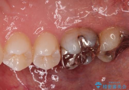 歯茎がはれてきた 根の治療をしてからのセラミック装着の治療前
