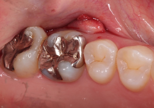 歯茎がはれてきた 根の治療をしてからのセラミック装着の治療前