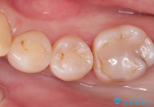 プレスセラミックインレー。精度にこだわるの治療後