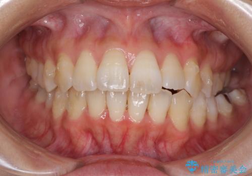 インビザラインで機能面に問題のある歯列を改善の治療中