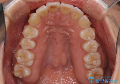 インビザラインで機能面に問題のある歯列を改善の治療中