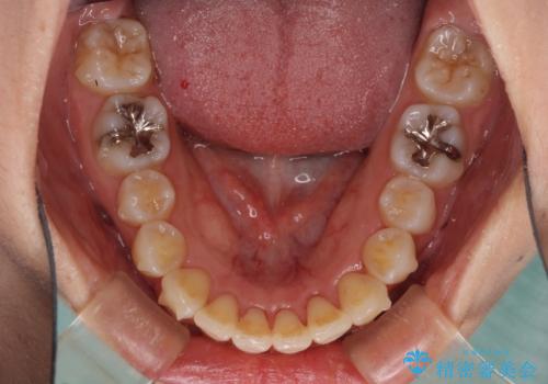 インビザラインで機能面に問題のある歯列を改善の治療中