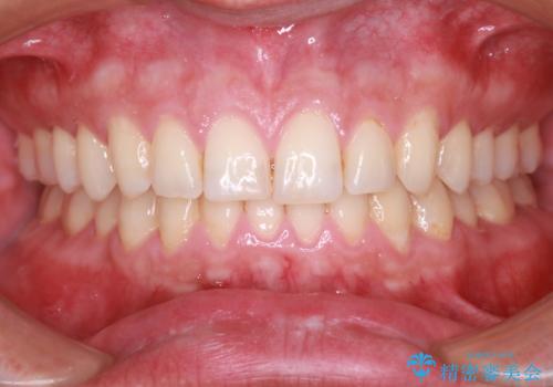 下の前歯のがたがたを治したい。インビザラインライトの治療後