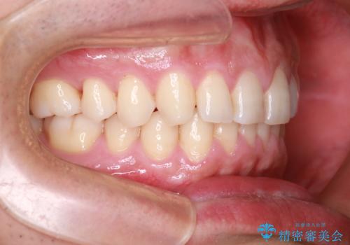 下の前歯のがたがたを治したい。インビザラインライトの治療後