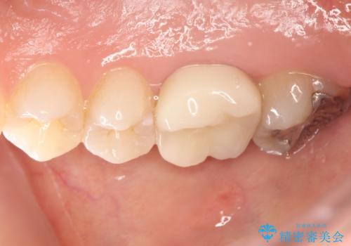歯茎がはれてきた 根の治療をしてからのセラミック装着の治療後