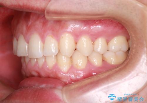 下の前歯のがたがたを治したい。インビザラインライトの治療後