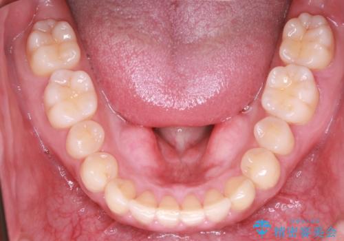 下の前歯のがたがたを治したい。インビザラインライトの治療後