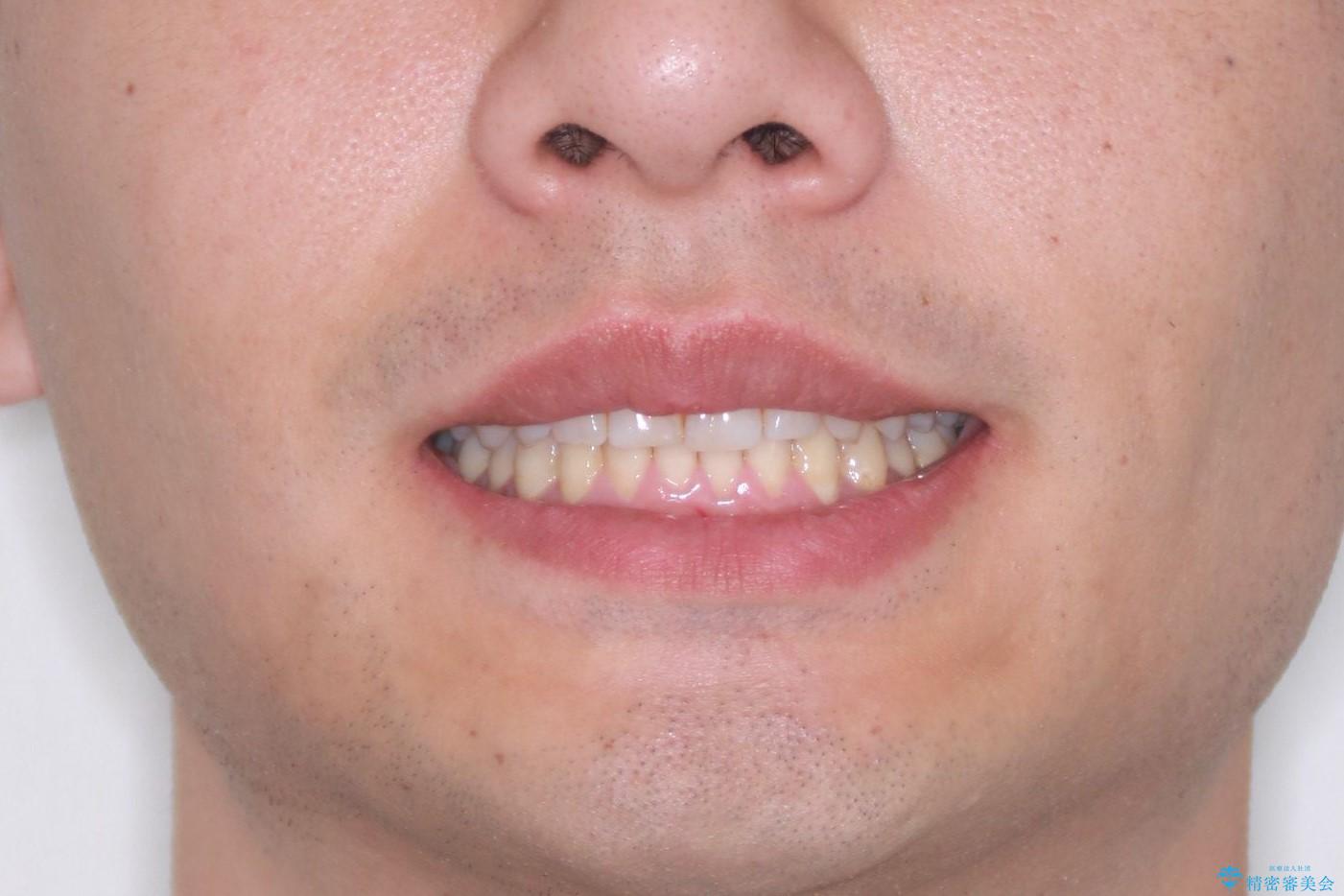 下の前歯のがたがたを治したい。インビザラインライトの治療後(顔貌)
