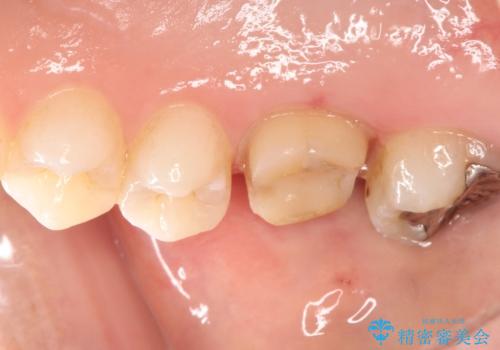 歯茎がはれてきた 根の治療をしてからのセラミック装着の治療中