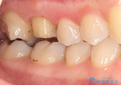 歯茎がはれてきた 根の治療をしてからのセラミック装着の治療中