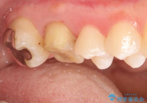 歯茎がはれてきた 根の治療をしてからのセラミック装着の治療中