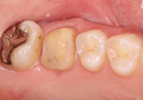 歯茎がはれてきた 根の治療をしてからのセラミック装着の治療中