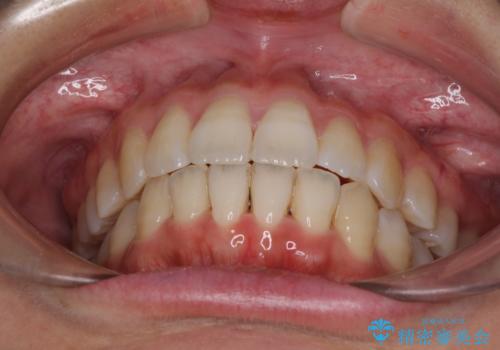 インビザラインで機能面に問題のある歯列を改善の治療後