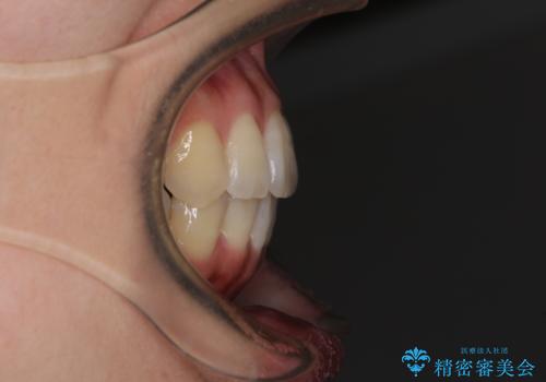 インビザラインで機能面に問題のある歯列を改善の治療後